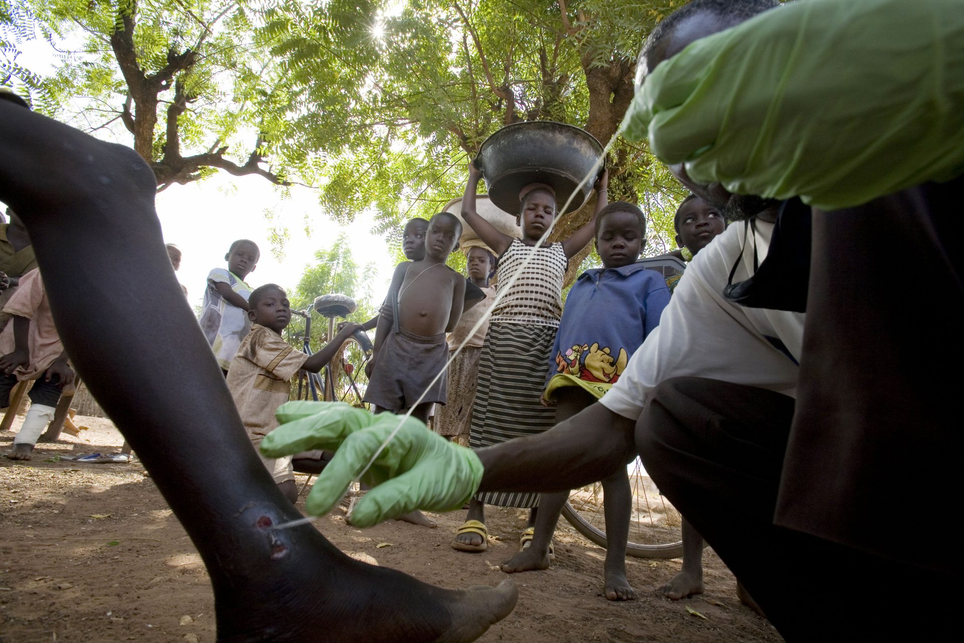 The Guinea Worm is the stuff of nightmares